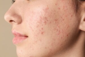 a close up acne on sensitive skin