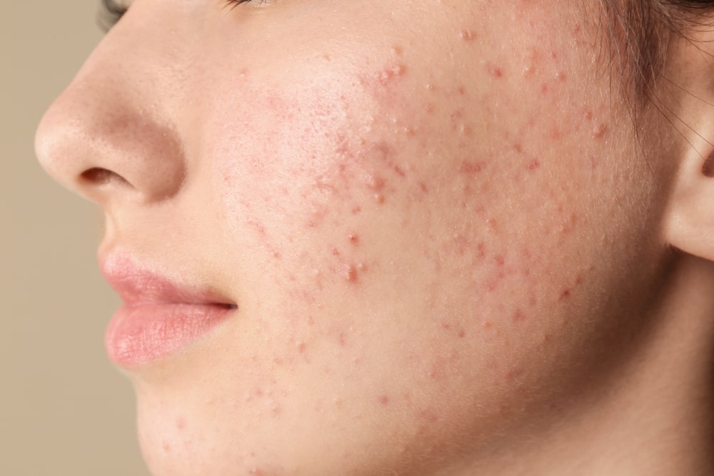 a close up acne on sensitive skin